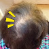 【微增髮片】頭皮外露曬到太陽會痛 阿姨這樣處理