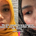 Siapa Yang Berjerawat Tak Nak Baca Artikel Ini, Rugi!