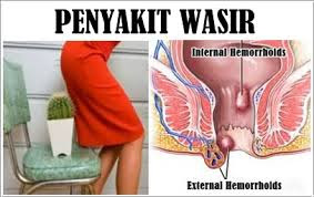 Foto Obat Alami Mengobati Benjolan Wasir Yang Tak Kunjung Sembuh Menahun