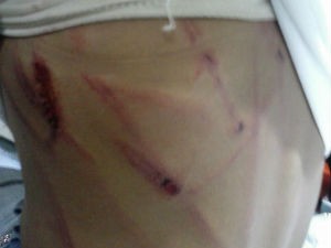 Crianças foi socorrida pelo Samu e ficou com marcas da agressão (Foto: Jadiel Luiz / Blog do Sigi Vilares)