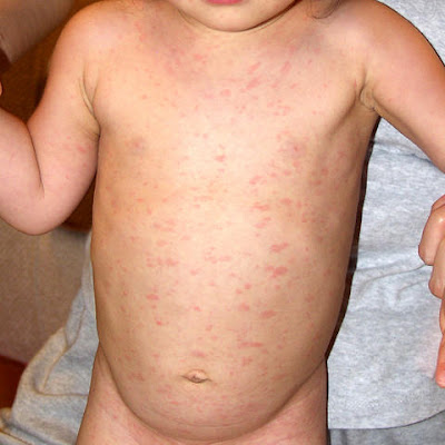 zika rashes #11