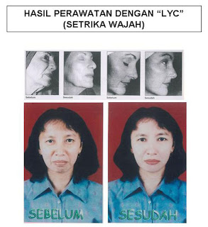 Setrika Wajah: HASIL PERAWATAN SETRIKA WAJAH