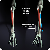 Los Angeles Foot Expert: Shin Splints