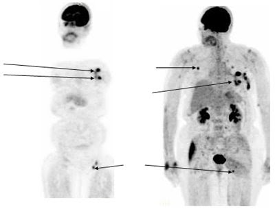 NonHodgkin's Lymphoma PET CT Scan
