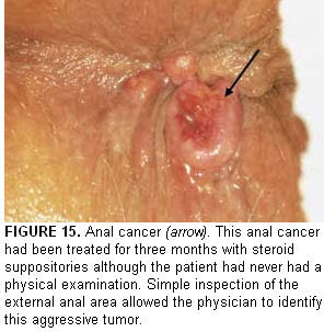 Causes of anal leakage — pic 9