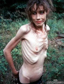 Anorexic Fetish Nude 109