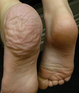 Proteus Syndrome affected foot