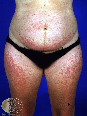 Pruritic urticarial papules and plaques of pregnancy ...