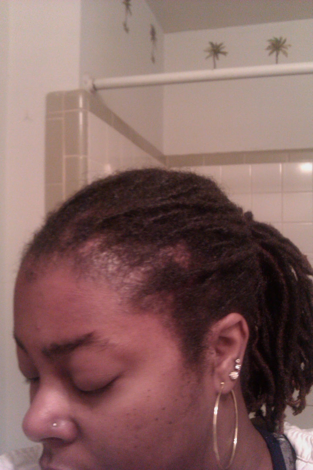 honey dipped locs busted hairline