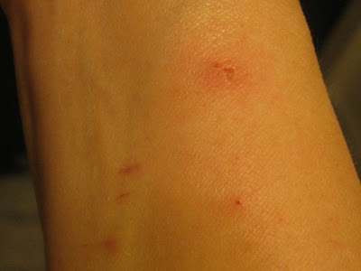 aar110yxi: poison oak rash photos