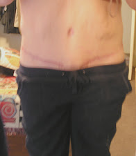 He cut the front open again.  But no more little hole or puckering
