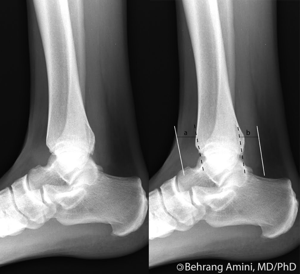 Roentgen Ray Reader Ankle Effusions and Trauma