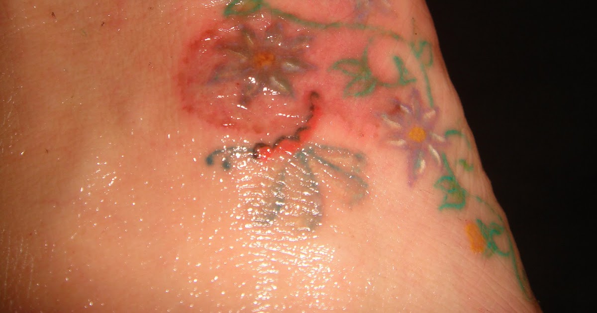 Tattoo Removal Using TCA: 4th Day--Pictures and observations
