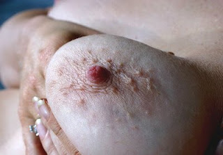 Big Bumpy Nipples 89