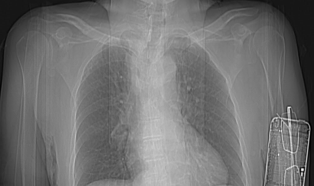 Radiology MRI: iPhone on CT Scanogram