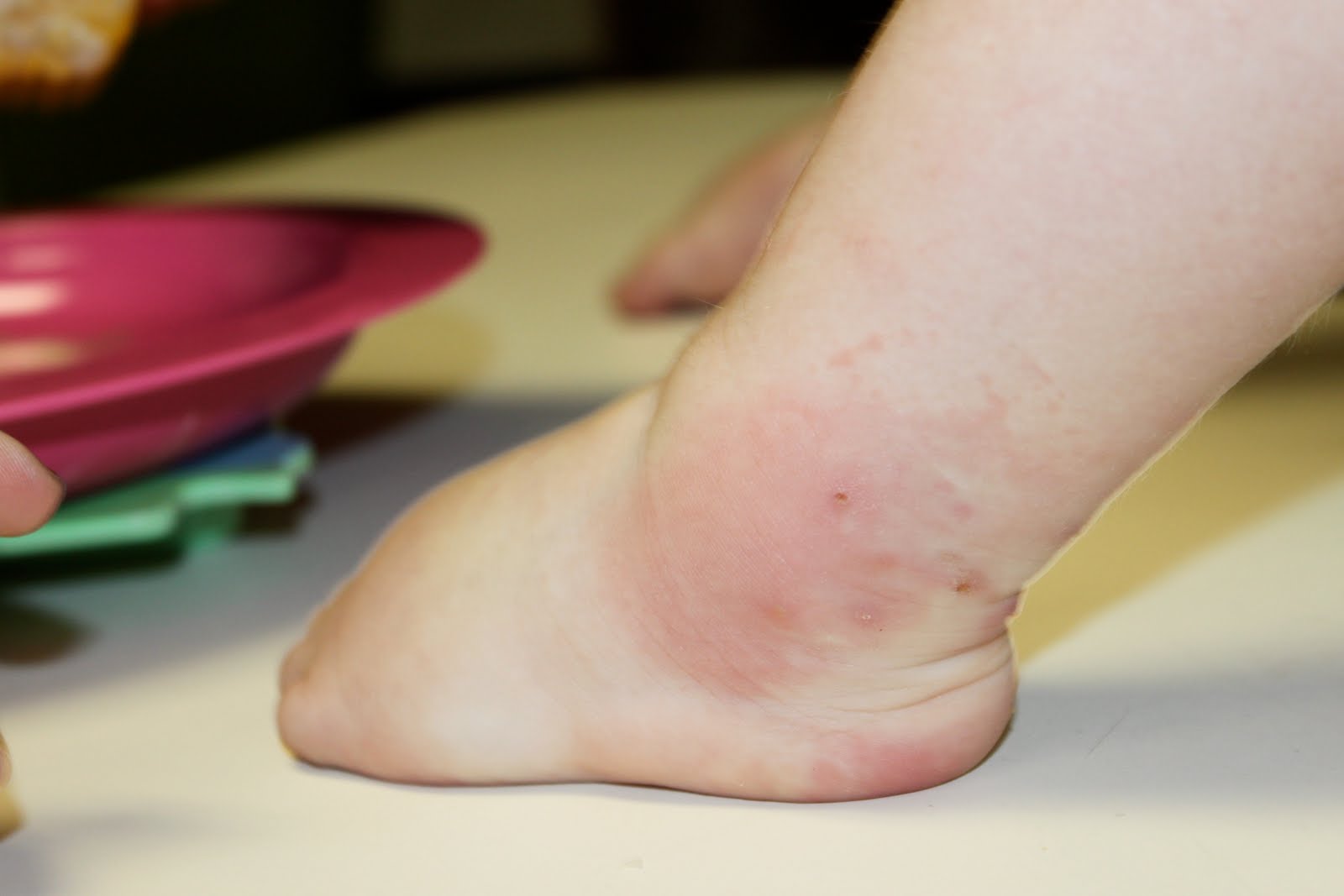 mojoy-gabbi-girl-s-ant-bites