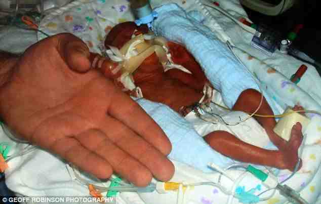 Boy born at 23 weeks, now preparing for pre-school baby abortion diagram 
