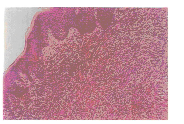 Вид эпулиса в зависимости от гистологической картины