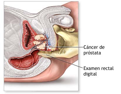 http://2.bp.blogspot.com/_3IXU7P7O5pM/S8YpSs2XipI/AAAAAAAAAO0/4dKkQaLPWuM/s1600/cancer+de+prostata.bmp