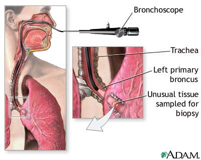 Биопсия легких как проводится