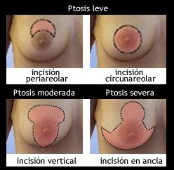 [incisiones+elevacion+copia.jpg]