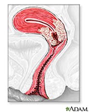 Cancer De Cuello Uterino Sintomas Imagenes - 6 Sintomas de Cancer de Cuello Utero