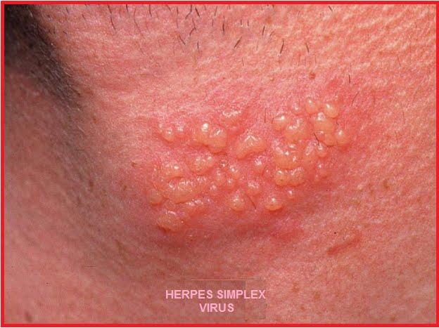 herpes simplex okoz e fogyást
