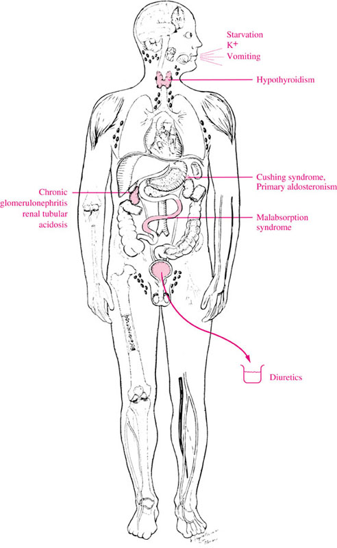 SYMPTOMS AND CAUSES OF HYPOKALEMIC PERIODIC PARALYSIS: Hypokalemia ...