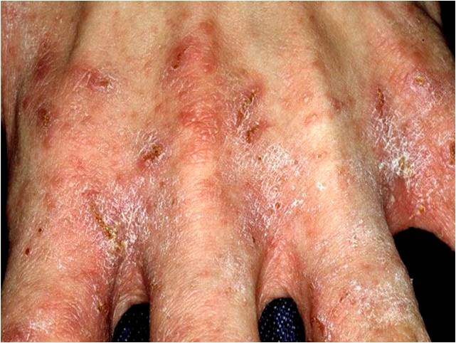 7 year itch scabies 7 year itch scabies