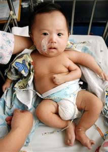 Baby with 3 Arms Born in China