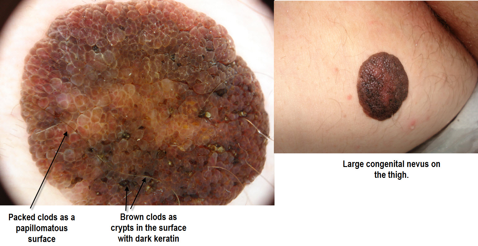 Giant congenital nevus: MedlinePlus Medical Encyclopedia