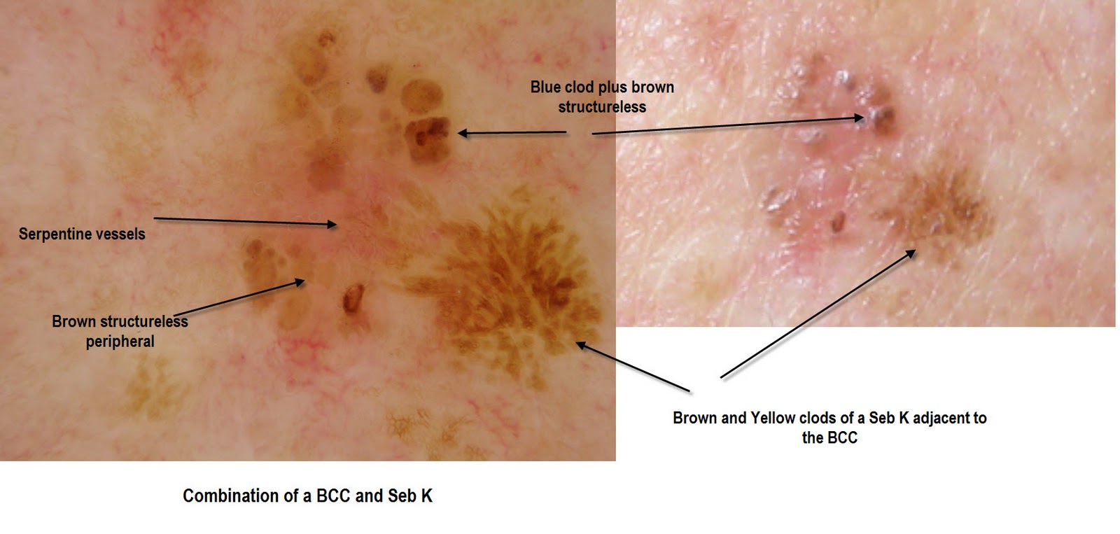 What is Invasive Squamous Cell Carcinoma? (with pictures)