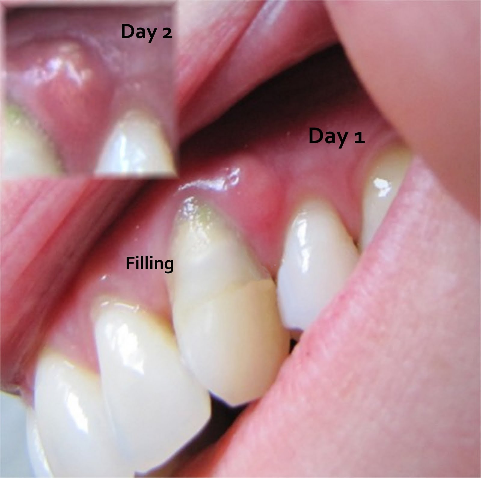 Gum Abscess