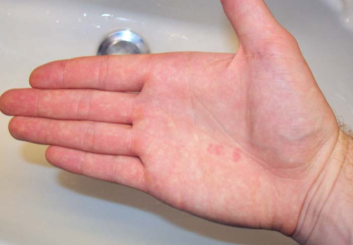 red spots on palm of hand