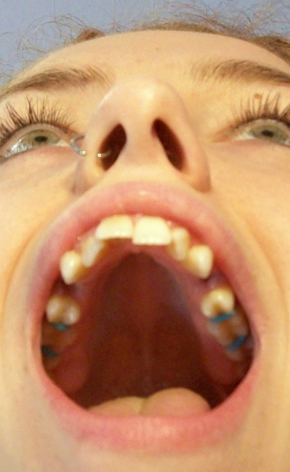 Braces at twenty Spacer and Extraction pictures