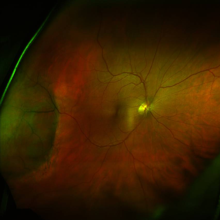Повреждение сетчатки. Макулярный ретиношизис сетчатки. Ювенильный ретиношизис. Ретиношизис сетчатки окт. Периферический ретиношизис глаза.