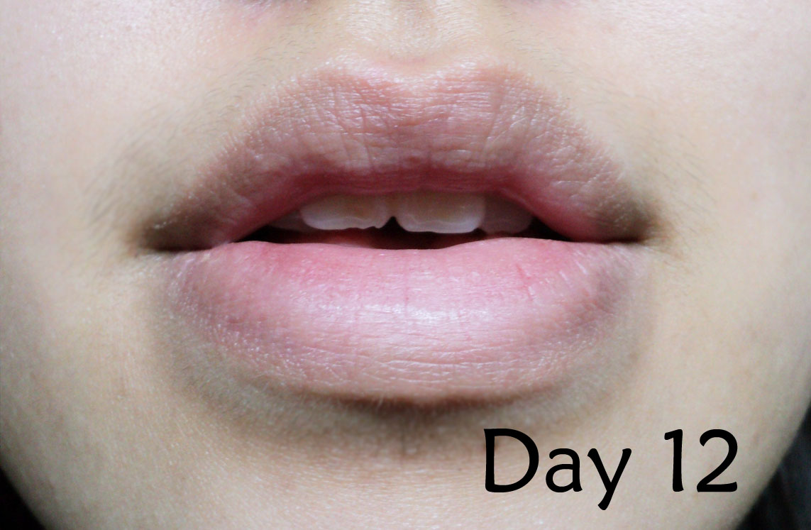 dry patch on lip – Dermatology – MedHelp