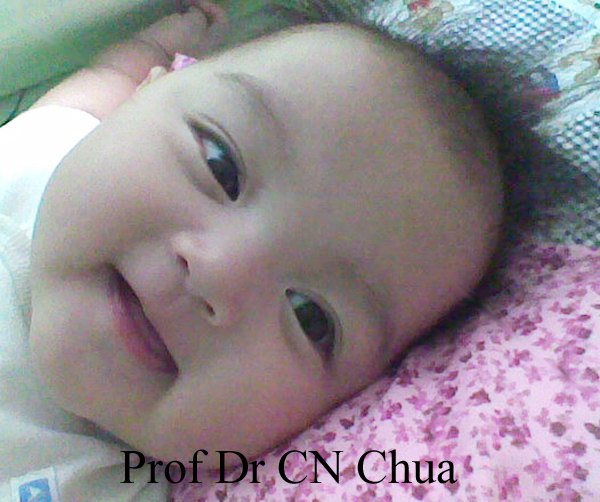 Eyelid Surgery by Prof Dr CN CHUA 蔡鐘能 Sometimes You See Them Sometimes