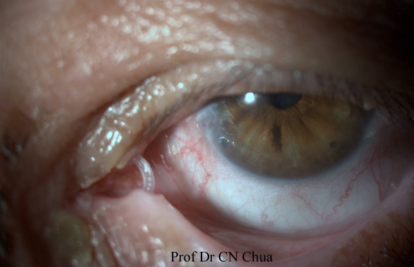 Eyelid Surgery By Prof Dr Cn Chua U8521 U9418 U80fd Ma U0026 39 Am I Think You Have Swallowed The Tube