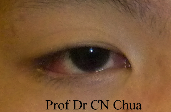 Eyelid Surgery by Prof Dr CN CHUA 蔡鐘能: Doc, Can You Make Me Look Good ...