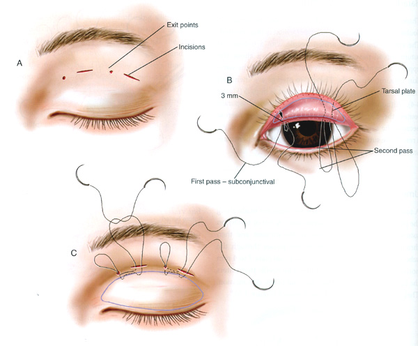 Incision Vs Suture Eyelid Surgery Asian 111