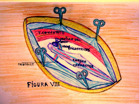 ojo clínico: HERNIA INGUINAL INDIRECTA (O EXTERNA).