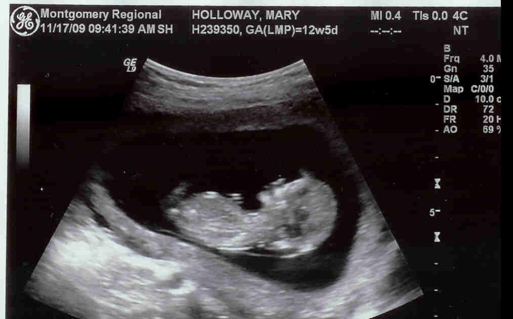 Dating scan at 11 weeks