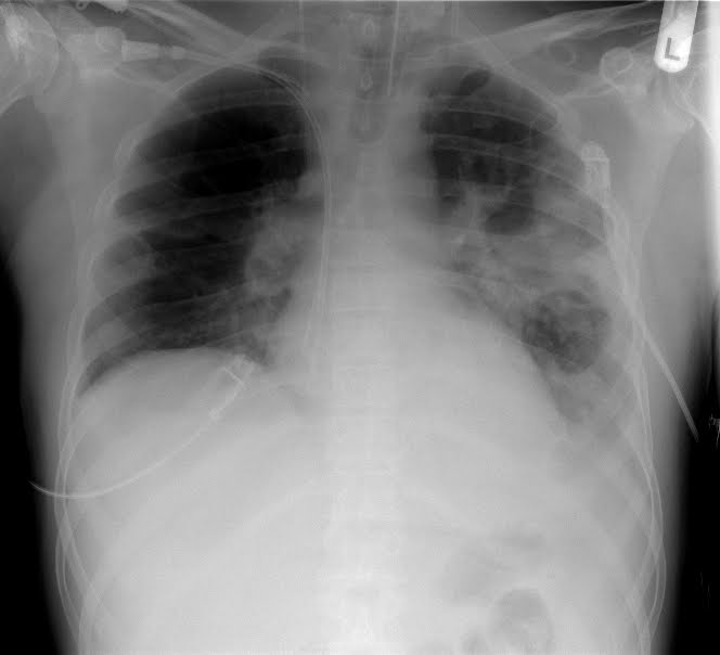 [XR_chest_-_pneumonia_with_abscess_and_caverns_-_d0.jpg]