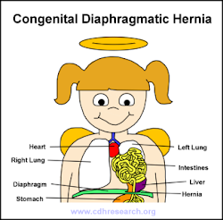 What is CDH?