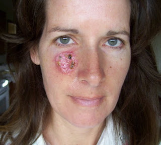 Mohs Surgery as a Skin Cancer Therapy