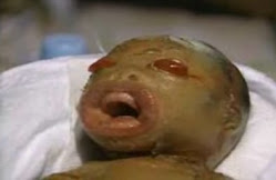 Harlequin Ichthyosis