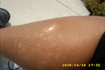 Leg attack of Vitiligo-small spots