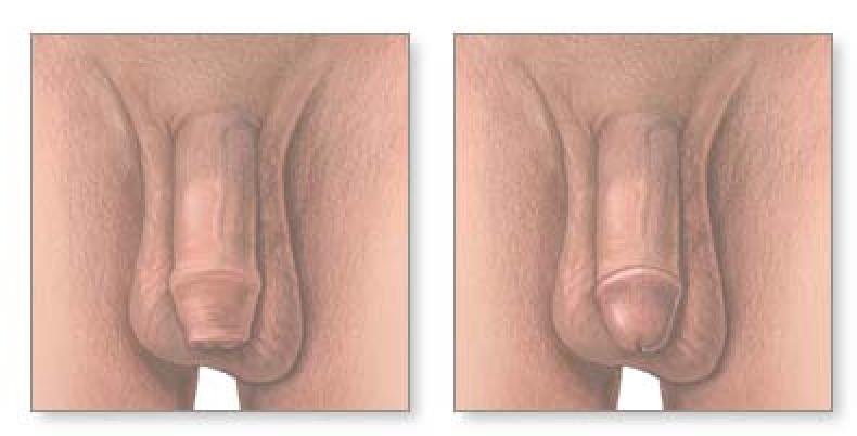 Circumcised Vs Uncircumcised Penis 76