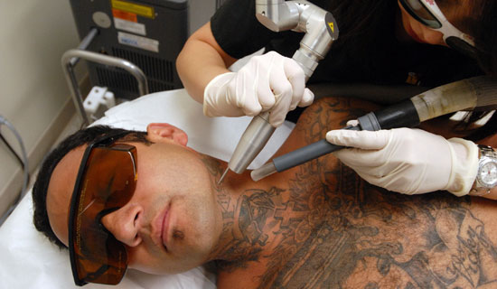 Tattoo removal is a laser procedure that is growing in popularity as more